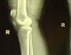 骨折可以吃小白瓜吗,小白瓜的适宜摄入